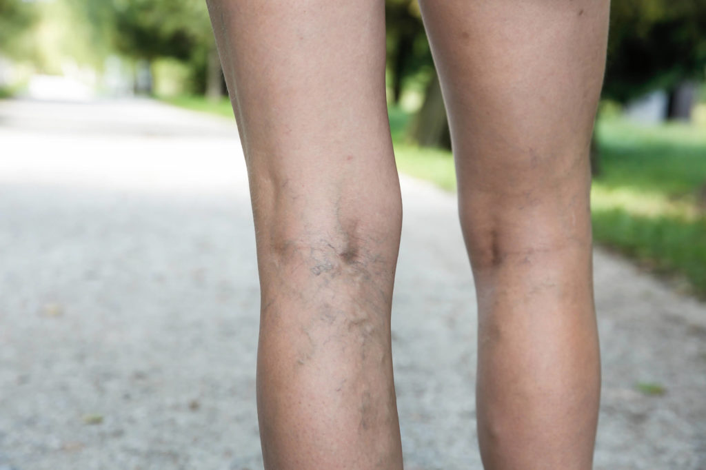 Varicose Veins Treatment: Is Treatment Permanent? - Worcester