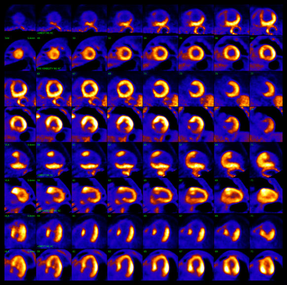 cardiac-pet-scan-viability