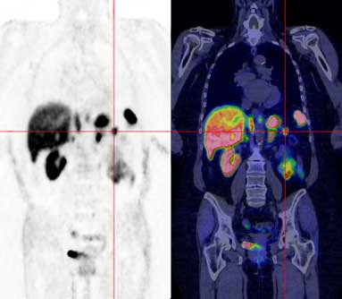 DotaTATE-PET-Scan-Oncology