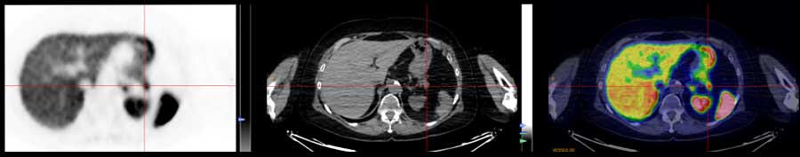 DotaTATE-SSTR-PET-Scan