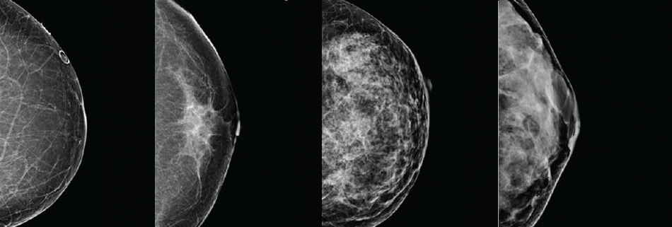 Dense-Breast-Tissue
