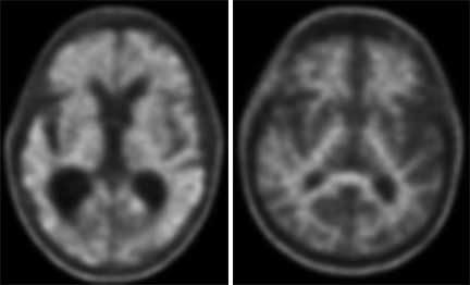 Amyloid-PET-Positive-vs-Negative