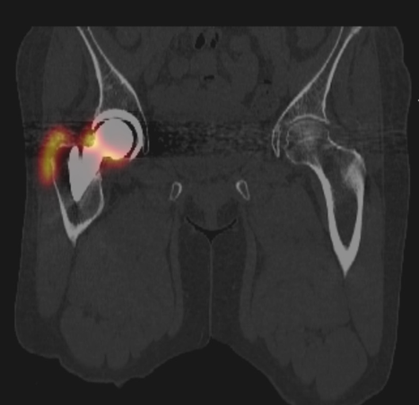 nuclear-medicine-arthrogram