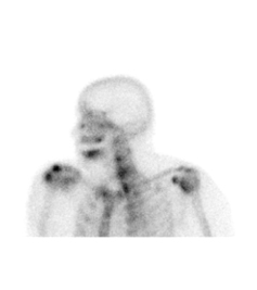 nuclear-medicine-bone-scan