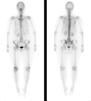 nuclear-medicine-bone-scan