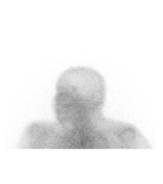 nuclear-medicine-gallium-scan
