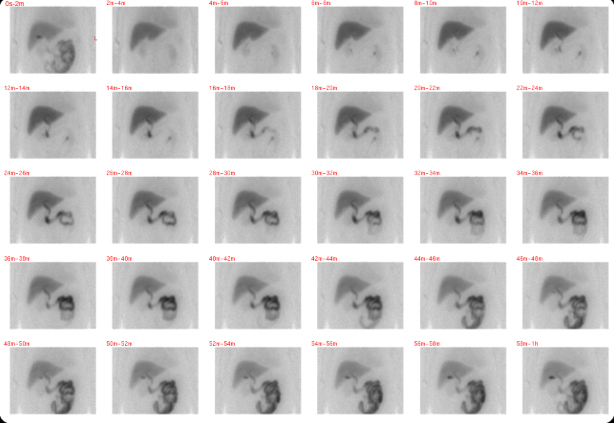 nuclear-medicine-hida-hepatobiliary-scan