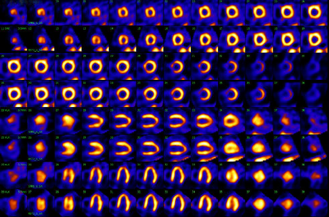 cardiac-nuclear-medicine-myocardial-perfusion-imaging-MPI-MIBI