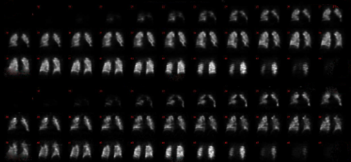 nuclear-medicine-lung-ventilation-perfusion-imaging-exam